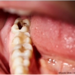 How to Prevent Cavities Naturally at Home