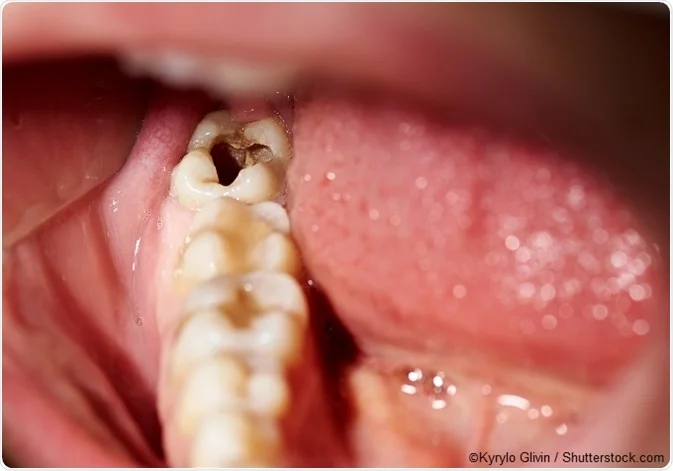 How to Prevent Cavities Naturally at Home