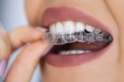 How do dental aligners work