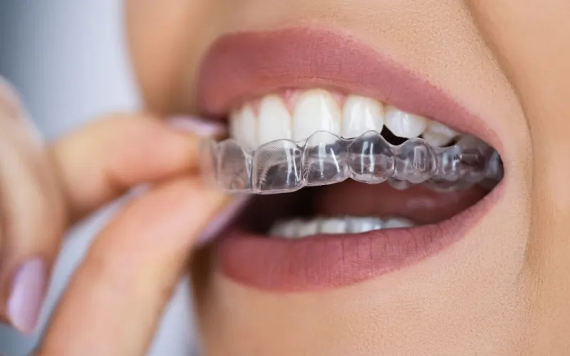 How do dental aligners work